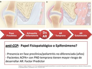 anti-CCPanti-CCP:: Papel Fisiopatológico o Epifenómeno?
- Presencia en fase preclínica/poliartritis no diferenciada (años)
- Pacientes ACPA+ con PND temprana tienen mayor riesgo de
desarrollar AR: Factor Predictor
Szodoray P, Szabó Z, Kapitány A, et al. Anti-citrullinated protein/peptide autoantibodies in association with genetic and environmental factors as indicators of disease outcome
in rheumatoid arthritis. Autoimmunity reviews. 2010;9(3):140-3.
 