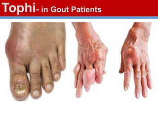 Tophi- in Gout Patients
 