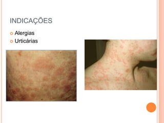 INDICAÇÕES
 Alergias
 Urticárias
 