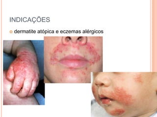 INDICAÇÕES
   dermatite atópica e eczemas alérgicos
 