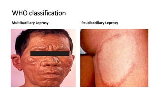 WHO classification
Multibacillary Leprosy Paucibacillary Leprosy
 