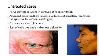 Untreated cases
• Nerve damage resulting in paralysis of hands and feet.
• Advanced cases- multiple injuries due to lack of sensation resulting in
the apparent loss of toes and fingers.
• Corneal ulcers and blindness.
• loss of eyebrows and saddle-nose deformity.
 