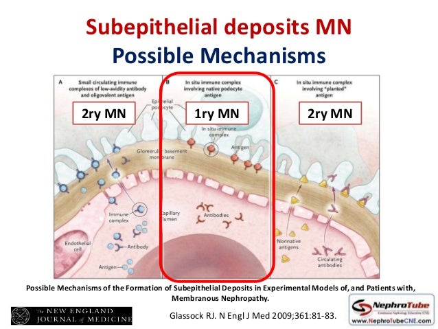 Anti-Phospholipase A2 Receptor Antibody - Clinical Application for