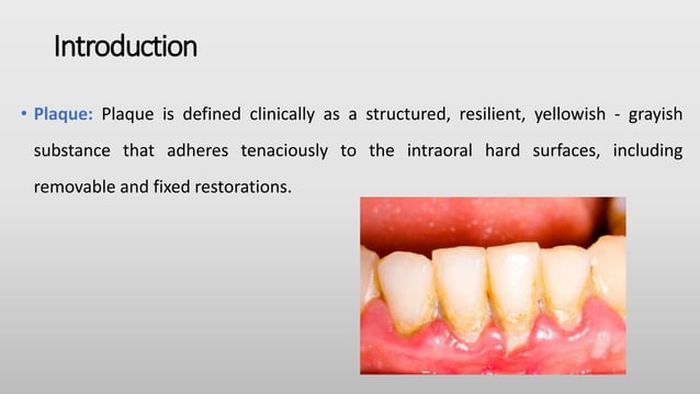 Anti plaque agents, Dr Sai Lakshmi | PPT