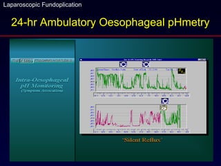 24-hr Ambulatory Oesophageal pHmetry 