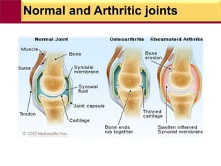 Normal and Arthritic joints
 