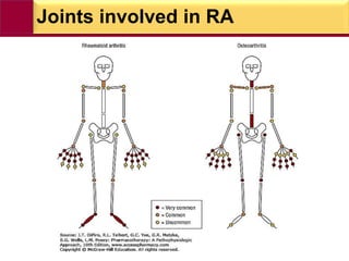 Joints involved in RA
 