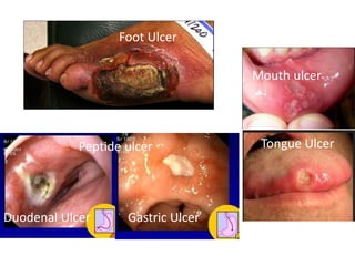 Foot Ulcer
Mouth ulcer
Tongue Ulcer
Foot Ulcer
Duodenal Ulcer Gastric Ulcer
Peptide ulcer
 