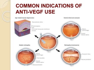 COMMON INDICATIONS OF
ANTI-VEGF USE
 
