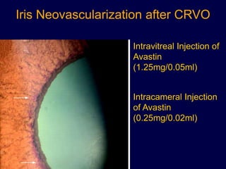 Iris Neovascularization after CRVO
Intravitreal Injection of
Avastin
(1.25mg/0.05ml)
Intracameral Injection
of Avastin
(0.25mg/0.02ml)
 
