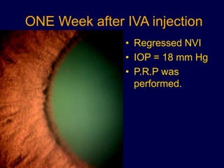 ONE Week after IVA injection
• Regressed NVI
• IOP = 18 mm Hg
• P.R.P was
performed.
 