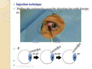  Injection technique
 Pulling the conjunctiva over the injection site with forceps
or a sterile cotton swab to create a steplike entry path.
 The needle is removed, and a sterile cotton swab is
immediately placed over the injection site to prevent
reflux.
 IOP and CRA perfusion is assessed.
 Topical Antibiotic is administered for one week
 