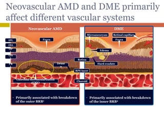 30
Neovascular AMD and DME primarily
affect different vascular systems
• Primarily associated with breakdown
of the inner BRB2
• Primarily associated with breakdown
of the outer BRB1
1. Cummings M, Cunha-Vaz J. Clin Ophthalmol 2008;2:369–375
2. Bhagat N et al. Surv Ophthalmol 2009;54:1–32
Neovascular AMD DME
RPE layer
Retinal capillaryMicroaneurysm
Fovea Fovea
Choroid
Druse
n
PR
L
ON
L
INL
IPL
OP
L
IPL, inner plexiform layer; INL, inner nuclear layer; OPL, outer
plexiform layer; ONL, outer nuclear layer; PRL, photoreceptor layer
Choroidal neovascularization
(CNV)
Edema
Retina
Hard exudate
 