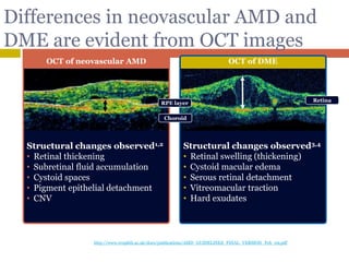 31
Structural changes observed1,2
• Retinal thickening
• Subretinal fluid accumulation
• Cystoid spaces
• Pigment epithelial detachment
• CNV
OCT of neovascular AMD
Structural changes observed3,4
• Retinal swelling (thickening)
• Cystoid macular edema
• Serous retinal detachment
• Vitreomacular traction
• Hard exudates
OCT of DME
Differences in neovascular AMD and
DME are evident from OCT images
1. Liakopoulos S et al. Invest Ophthalmol Vis Sci 2008;49:5048–5054
2. The Royal College of Ophthalmologists. AMD: guidelines for management. 2009.
http://www.rcophth.ac.uk/docs/publications/AMD_GUIDELINES_FINAL_VERSION_Feb_09.pdf [accessed Sep 2009]
3. Bhagat N et al. Surv Ophthalmol 2009;54:1–32
4. Lang GE. In Developments in ophthalmology. 2007. p31–47
Retina
RPE layer
Choroid
 