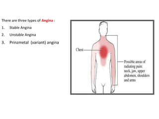 There are three types of Angina :
1. Stable Angina
2. Unstable Angina
3. Prinzmetal (variant) angina
 