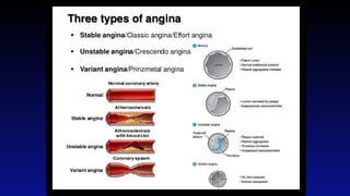 Comprehensive Overview of Anti-Anginal Drugs and Their Clinical Use | PPTX