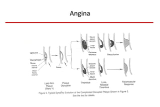 Angina 