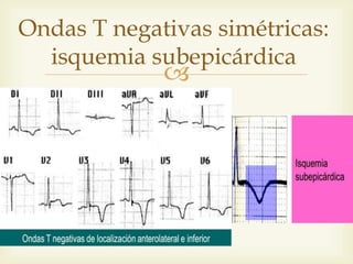 
Ondas T negativas simétricas:
isquemia subepicárdica
 