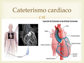 
Cateterismo cardiaco
 