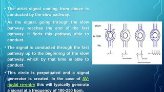 • The atrial signal coming from above is
conducted by the slow pathway.
• As the signal, going through the slow
pathway, reaches the end of the fast
pathway, it finds this pathway able to
conduct.
• The signal is conducted through the fast
pathway up to the beginning of the slow
pathway, which by that time is able to
conduct.
• This circle is perpetuated and a signal
generator is created. In the case of AV-
nodal re-entry this will typically generate
a signal at a frequency of 180-250 bpm.
 