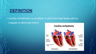 DEFINITION
• Cardiac Arrhythmia is a condition in which the heart beats with an
irregular or abnormal rhythm.
 