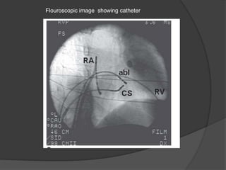 Flouroscopic image showing catheter
 