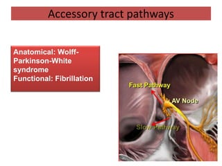 Anatomical: Wolff-
Parkinson-White
syndrome
Functional: Fibrillation
Accessory tract pathways
 