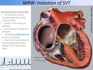 WPW: Initiation of SVT
Supraventricular tachycardia
• initiated by a closely
coupled premature atrial
complex (PAC)
• blocks in the accessory
pathway
• but conducts through the
AV node
• retrograde conduction via
accessory pathway
• inverted P wave produced
by retrograde conduction
visible in the inferior ECG
leads
 