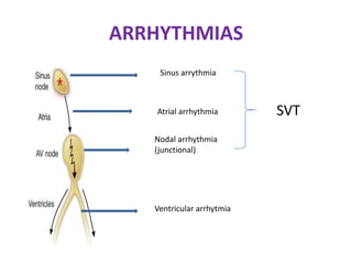 ARRHYTHMIAS
Sinus arrythmia
Atrial arrhythmia
Nodal arrhythmia
(junctional)
Ventricular arrhytmia
SVT
 