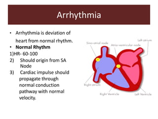 Arrhythmia
• Arrhythmia is deviation of
heart from normal rhythm.
• Normal Rhythm
1)HR- 60-100
2) Should origin from SA
Node
3) Cardiac impulse should
propagate through
normal conduction
pathway with normal
velocity.
 