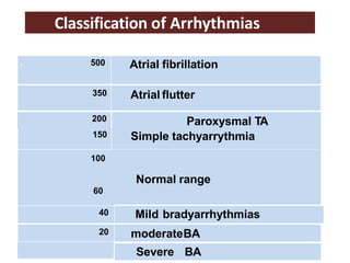 100
60
Normal range
150 Simple tachyarrythmia
200 Paroxysmal TA
. 500 Atrial fibrillation
350 Atrial flutter
40 Mild bradyarrhythmias
20 moderateBA
Severe BA
Classification of Arrhythmias
 