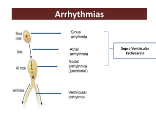 Arrhythmias
Sinus
arrythmia
Atrial
arrhythmia
Nodal
arrhythmia
(junctional)
Ventricular
arrhytmia
Supra Ventricular
Tachycardia
 