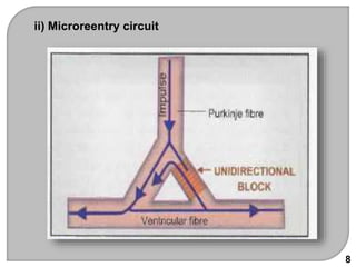 ii) Microreentry circuit
8
 