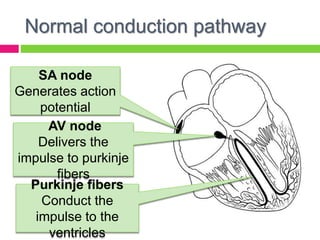 Normal conduction pathway
SA node
Generates action
potential
AV node
Delivers the
impulse to purkinje
fibers
Purkinje fibers
Conduct the
impulse to the
ventricles
 