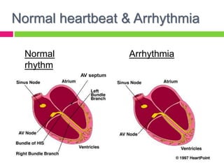 Normal heartbeat & Arrhythmia
Normal
rhythm
Arrhythmia
AV septum
 