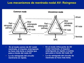 Los mecanismos de reentrada nodal AV: Reingreso




•    En el modo común de AV nodal       •   En el modo infrecuente de AV
    reentrada, el impulso anterógrada       nodal reentrada, el impulso
    se hace más lenta a medida que          anterógrada es rápido a medida
    pasa a través del nodo AV               que pasa a través del nodo AV
•   La vía retrógrada del circuito      •   La vía retrógrada del circuito de
    reentrante es rápido.                   reentrada se hace más lenta.
 