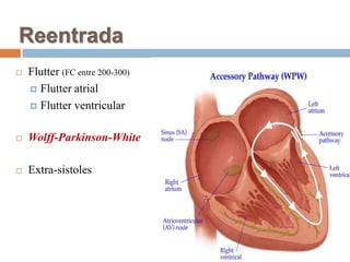 ReentradaFlutter(FC entre 200-300)Flutter atrialFlutter ventricularWolff-Parkinson-WhiteExtra-sistoles