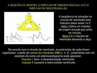 A SEQUÊNCIA MOSTRA A IMPULSO DE ORIGEM SINUSAL (I) E O
IMPULSO DE REENTRADA (II)
De acordo com o circuito de reentrada os potenciais de ação foram
registrados a partir de ramos do miocárdio (MB) α e β , juntamente com um
exemplo de como um eletrocardiograma pode aparecer.
Impulso I faria a despolarização ventricular
impulso II causaria a extra-sístole ventricular.
A seqüência de ativação no
circuito de reentrada está
indicado pelas setas I e II.
Seta I indica um impulso
de origem sinusal que entra
no circuito.
Seta II é o impulso de
reentrada deixando a alça.
 