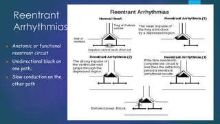 Reentrant
Arrhythmias
 Anatomic or functional
reentrant circuit
 Unidirectional block on
one path;
 Slow conduction on the
other path
.
 