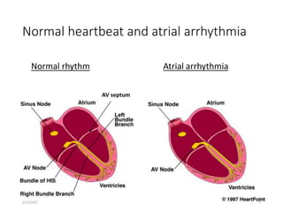 Normal heartbeat and atrial arrhythmia
Normal rhythm Atrial arrhythmia
AV septum
2/12/2022 5
 