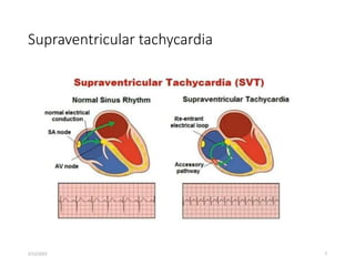Supraventricular tachycardia
2/12/2022 7
 