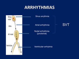 ARRHYTHMIAS
Sinus arrythmia
Atrial arrhythmia
Nodal arrhythmia
(junctional)
Ventricular arrhytmia
SVT
 