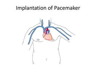 Implantation of Pacemaker
 