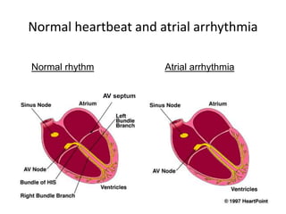 Normal heartbeat and atrial arrhythmia
Normal rhythm Atrial arrhythmia
AV septum
 