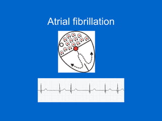 Atrial fibrillation                                                                                                                                                           