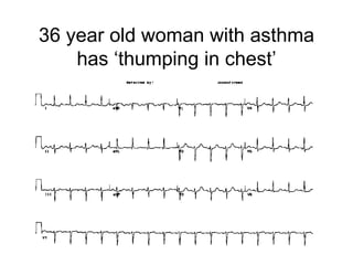 36 year old woman with asthma has ‘thumping in chest’ 