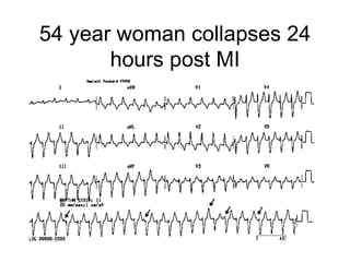 54 year woman collapses 24 hours post MI 