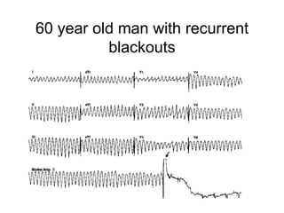 60 year old man with recurrent blackouts 