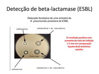 Detecção de beta-lactamase (ESBL)
O resultado positivo com
aumento do halo de inibição
≥ 5 mm em comparação
àquele do β-lactâmico
sozinho
Detecção fenotípica de uma amostra de
K. pneumoniae produtora de ESBL
 