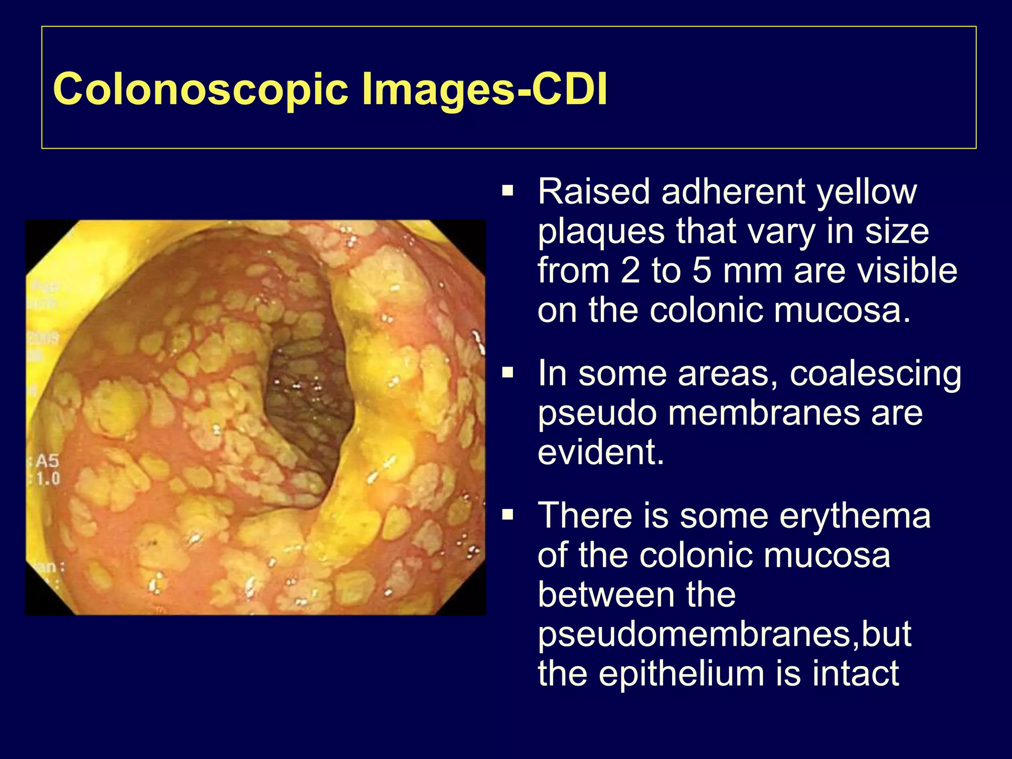 Antibiotic associated diarrhea & Clostridium difficile infection | PPTX